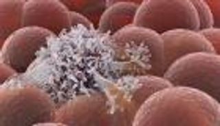 مفاجأة.. أقراص لـ"أسترازينيكا" تقلل تكرار الإصابة بسرطان الثدي