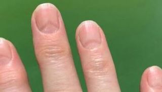 خطوط حمراء تشير إلى الإصابة بكورونا