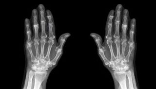 صورة أشعة تظهر هشاشة العظام في الأطراف