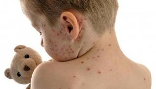 طفل يعاني من مرض الحصبة