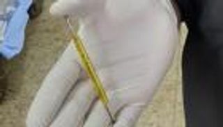 طبيب مصري يكشف لـ"العين الإخبارية" كواليس استخراج "مفك" من رأس مصاب.. صور صادمة