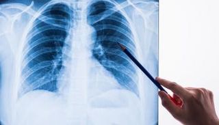 عدوى الفطر الأخضر  تؤثر على الرئتين - أرشيفية