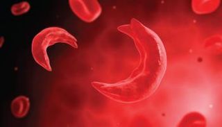  كريات الدم الحمراء تحت المجهر تأخذ شكلا مقوسا كالمنجل