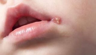 الهربس الفموي لدى الأطفال