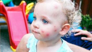 حساسية الحشرات عند الرضع