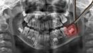 هذا ما يفعله خلع ضرس العقل بالتذوق