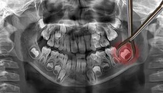 دراسة تكتشف فائدة لخلع ضرس العقل - صورة تعبيرية