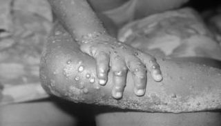 جدري القردة.. مرض فيروسي نادر