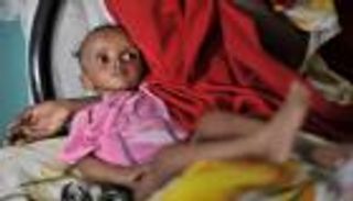 سوء التغذية الحاد يهدد حياة 100 ألف طفل في تيجراي بإثيوبيا