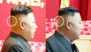 ضمادة على رأس زعيم كوريا الشمالية تثير حيرة العالم