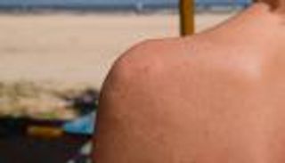 سرطان الجلد الفاتح.. أشكاله وأعراضه وطرق الوقاية 