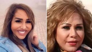الفنانة السورية مها المصري قبل وبعد عمليات التجميل