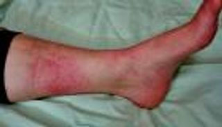 مرض الحمرة.. الأسباب والعلاج ومدى الخطورة