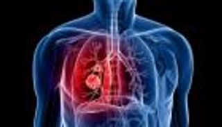 علاج واعد يقضي على أصعب أنواع سرطان الرئة