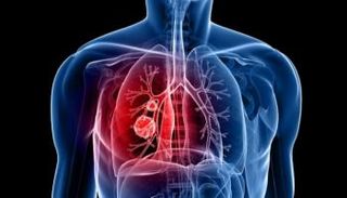 علاج واعد لمرضى سرطان الرئة ذو الخلايا غير الصغيرة (NSCLC)
