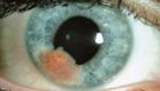 علاج جديد لأكثر أشكال سرطان العين شيوعاً.. نتائج مشجعة