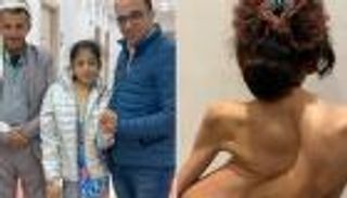 جراح مصري مغامر يعيد طفلة يمنية للحياة.. أصلح إعوجاجا نادرا بعمودها الفقري