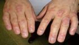 التهاب المفاصل الصدفي.. أعراض صعبة ومضاعفات خطيرة