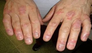 التهاب المفاصل الصدفي يتسبب في ظهور بقع جلدية حمراء 