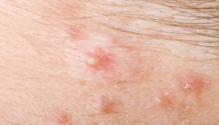 التهاب الغدد العرقية القيحي يحدث انسدادا للمسام