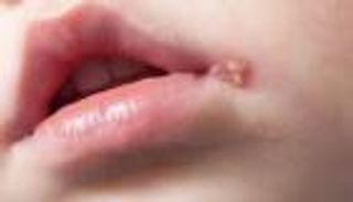 باستهداف الإنزيمات.. فيروسات الهربس تنهار في مواجهة مركبين جديدين