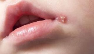 عائلة الهربس تضم تسعة أنواع