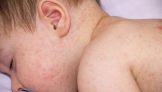 طفل تغطي علامات الحساسية جسده