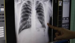 صورة أشعة لشخص مصاب بالسل - أرشيفية