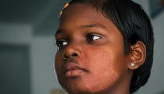 فتاة مصابة بمرض الجذام