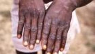 فيتنام تسجل أول إصابة بجدري القرود