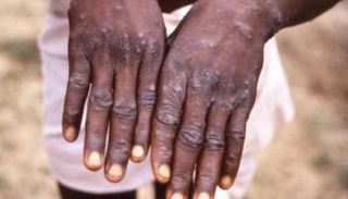 جدري القرود - أرشيفية