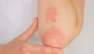 الصدفية والأطفال.. متاعب صحية وآلام نفسية