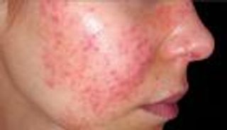 الذئبة الحمراء.. مرض خطير يؤثر على الدماغ والقلب والرئتين