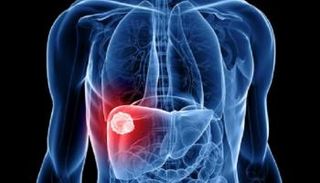 الاكتشاف يتيح الوقاية من  سرطان الكبد 
