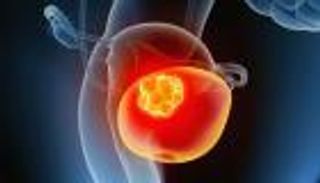 سرطان المثانة.. أسباب متعددة وأعراض تثير القلق