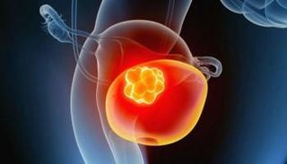 سرطان المثانة يصيب الرجال بمعدل أكبر من النساء