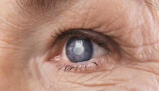 سيدة مصابة بالجلوكوما - أرشيفية