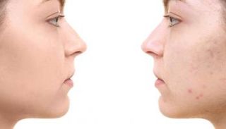 علاج البقع الداكنة