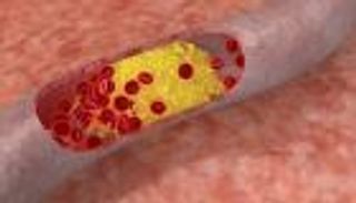 تصلب الشرايين.. 8 أسباب تزيد احتمالات الإصابة