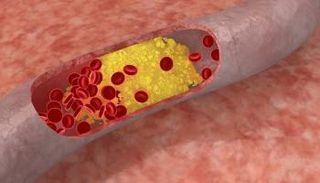تصلب الشرايين ينذر بأمراض القلب