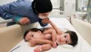 قصة شفا وصفا.. معجزة مستشفى جامعة أجيبادم أتاكنت لفصل توأم جزائري