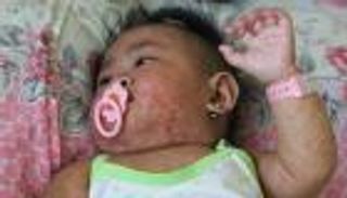 40 مليون طفل حول العالم لم يحصلوا على لقاح الحصبة