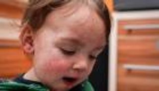 أعراض الحصبة الألمانية لدى الأطفال في الشتاء