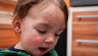 الإصابة بالحصبة الألمانية تبدأ بنزلة البرد