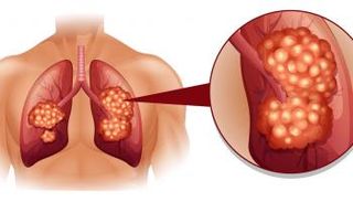 سرطان الرئة