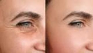 5 مستحضرات أثبتت كفاءة في علاج تجاعيد البشرة