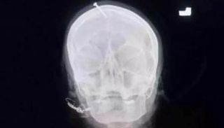 المسمار اخترق الجمجمة