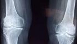 لقاحات "الرنا مرسال".. أحدث تقنية لعلاج كسور العظام