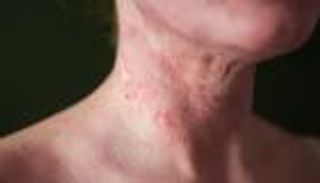 الطريقة السليمة للعناية ببشرة طفل مصاب بالتهاب الجلد التأتبي