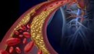 خفض مستويات الكوليسترول المرتفعة.. 5 طرق بسيطة